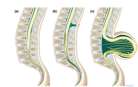 bufuda|Spina bifida